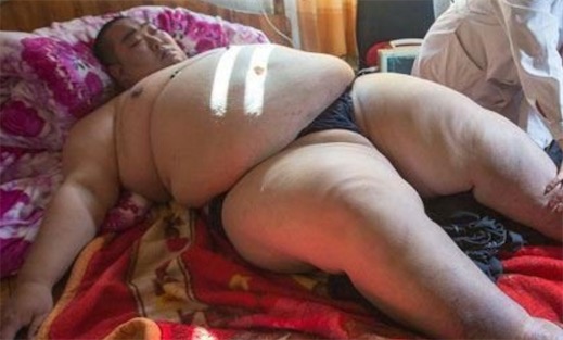 中国最胖的人 男子结扎后致体重达520斤