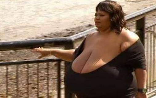 世界上最大的天然乳房 安妮・霍金斯・特纳双乳重达38.5公斤