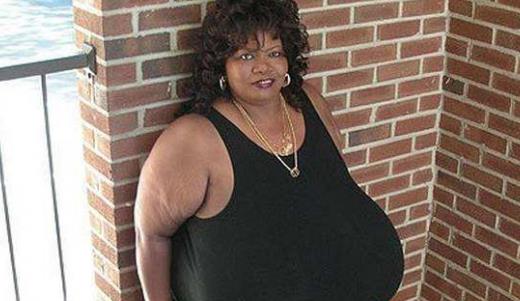 世界上最大的天然乳房 安妮・霍金斯・特纳双乳重达38.5公斤